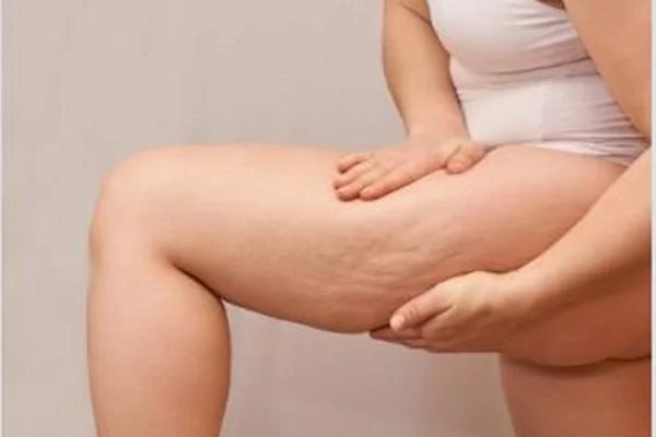 Lipedema: saiba o que causa o acúmulo de gordura no corpo