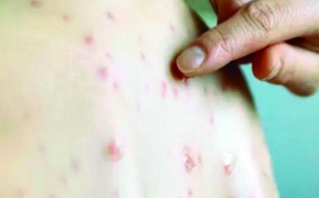 Ponta Porã: Suspeita de sarampo em bebê mobiliza autoridades de saúde