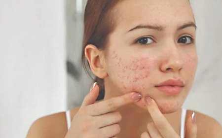 Roacutan no SUS: saiba quando e como conseguir acesso ao medicamento de forma gratuita