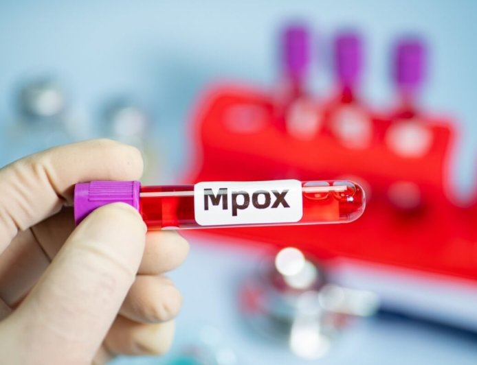 Sobe para 140 número de casos confirmados de Mpox no país, em 2026