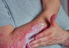 Alerta especialista: Alergia pode surgir na vida adulta e, em casos graves, levar à morte
