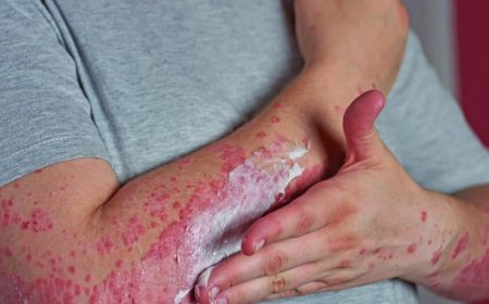 Alerta especialista: Alergia pode surgir na vida adulta e, em casos graves, levar à morte