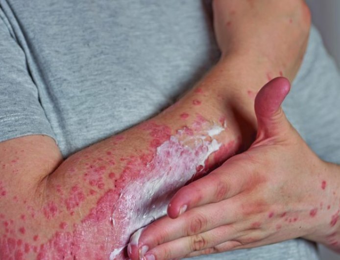Alerta especialista: Alergia pode surgir na vida adulta e, em casos graves, levar à morte