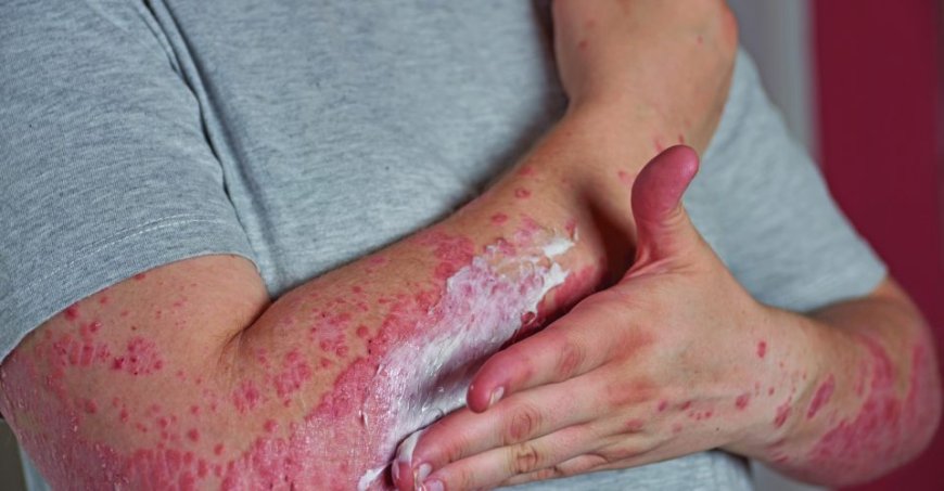Alerta especialista: Alergia pode surgir na vida adulta e, em casos graves, levar à morte