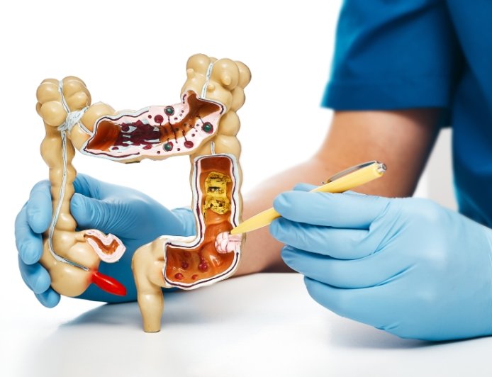 Em tratamento: Pacientes com câncer colorretal têm medicamento aprovado pela Anvisa