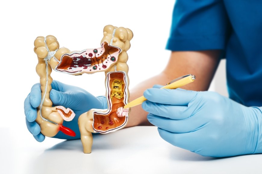 Em tratamento: Pacientes com câncer colorretal têm medicamento aprovado pela Anvisa