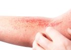Doença é crônica: Dermatite atópica impacta pele, sono e autoestima: saiba como tratar