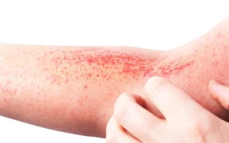 Doença é crônica: Dermatite atópica impacta pele, sono e autoestima: saiba como tratar