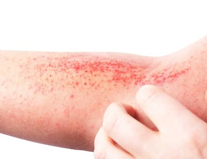 Doença é crônica: Dermatite atópica impacta pele, sono e autoestima: saiba como tratar