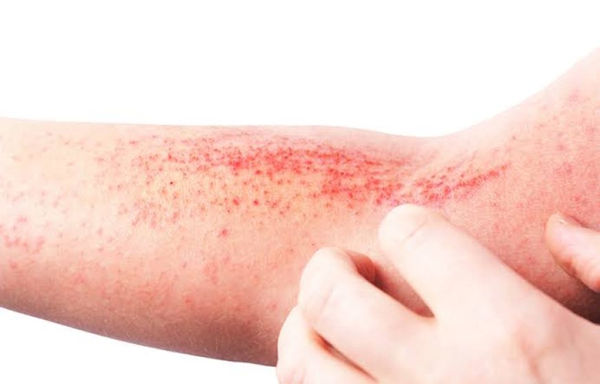 Doença é crônica: Dermatite atópica impacta pele, sono e autoestima: saiba como tratar